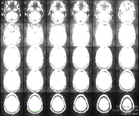 Motion-contaminated ACS